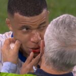 Kylian Mbappé et son nez fracturé