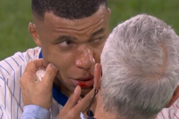 Kylian Mbappé et son nez fracturé