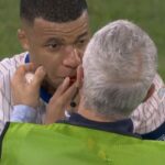 Kylian Mbappé et son nez fracturé